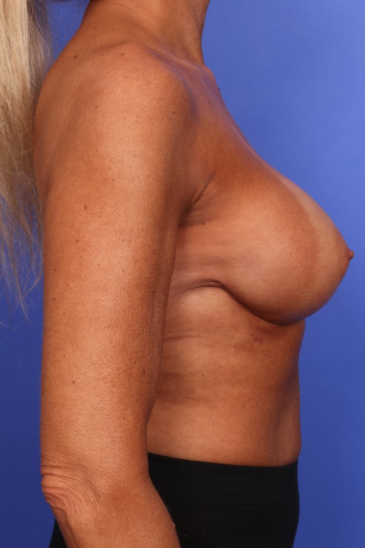 Corrective Breast Surgery Before & After Image