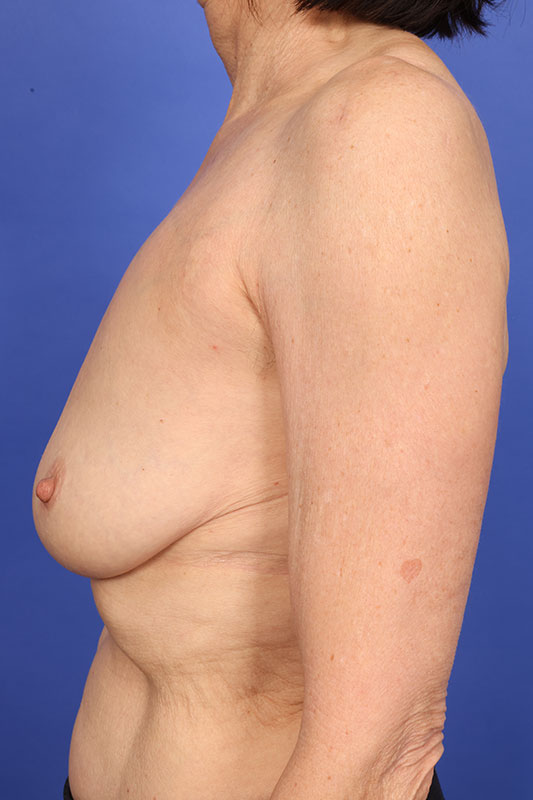 Corrective Breast Surgery Before & After Image