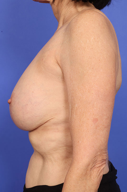Corrective Breast Surgery Before & After Image