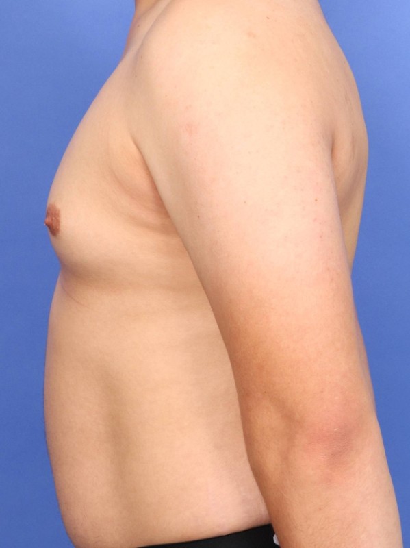 Gynecomastia Before & After Image