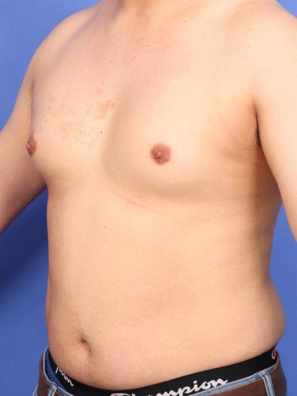 Gynecomastia Before & After Image