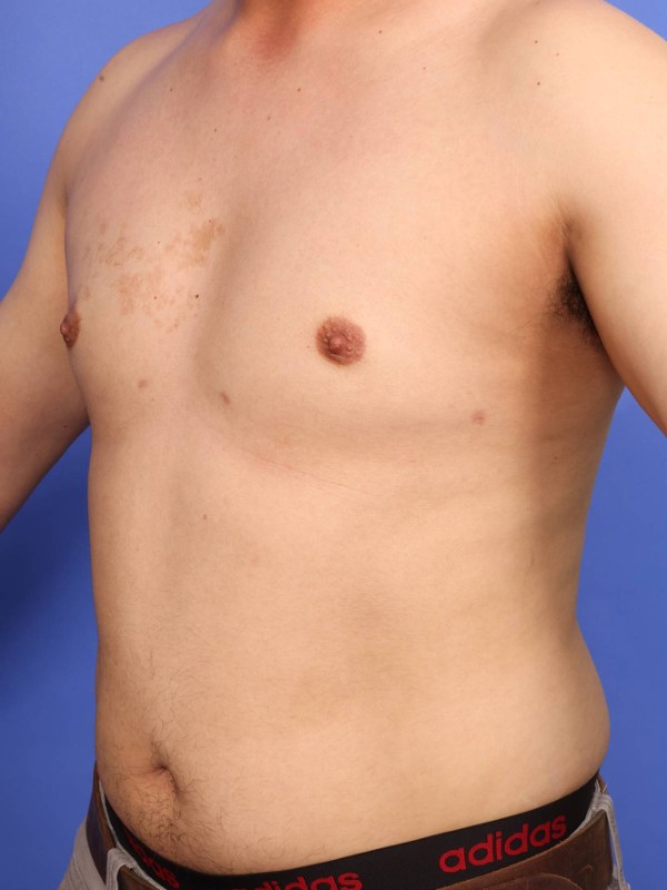 Gynecomastia Before & After Image