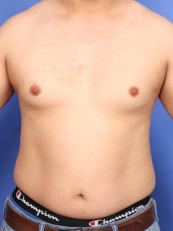 Gynecomastia Before & After Image