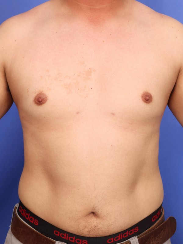 Gynecomastia Before & After Image