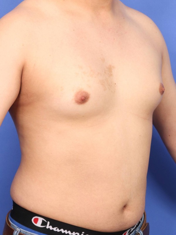 Gynecomastia Before & After Image