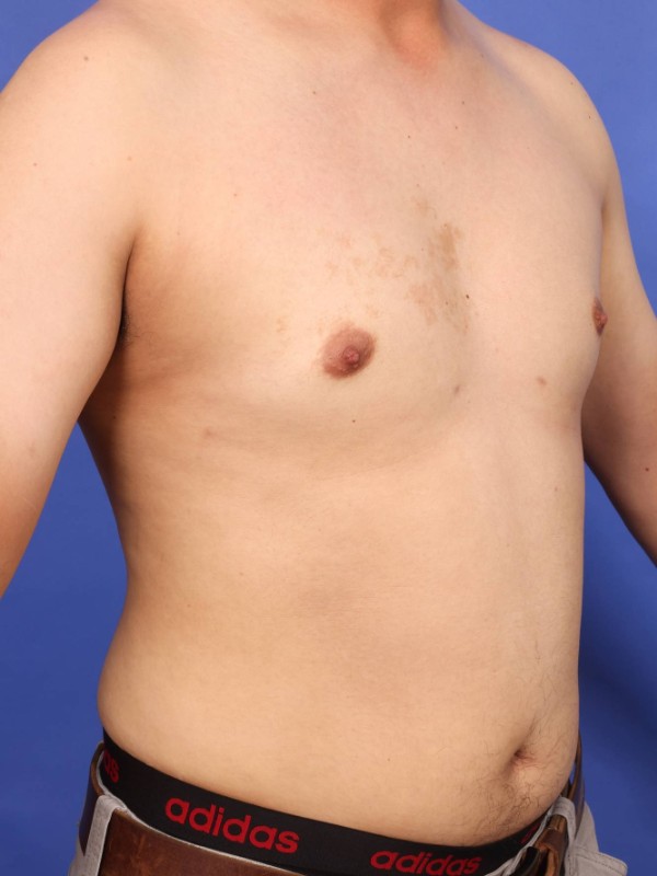 Gynecomastia Before & After Image