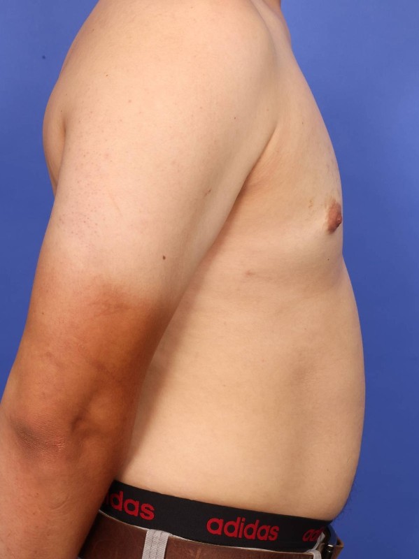 Gynecomastia Before & After Image