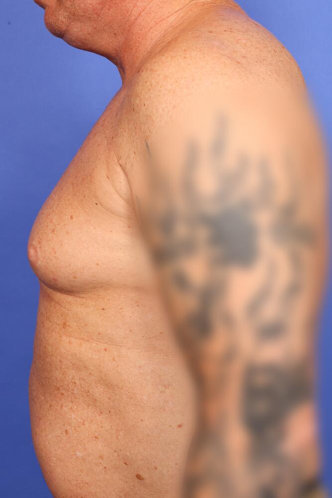 Gynecomastia Before & After Image