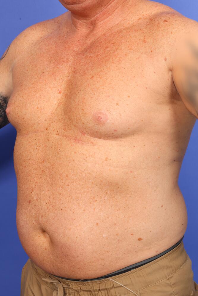 Gynecomastia Before & After Image