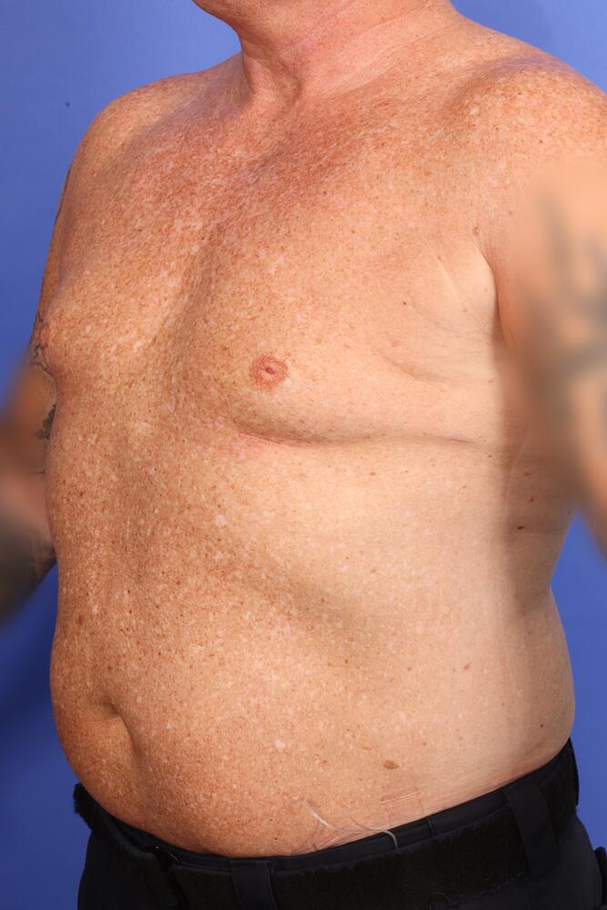 Gynecomastia Before & After Image