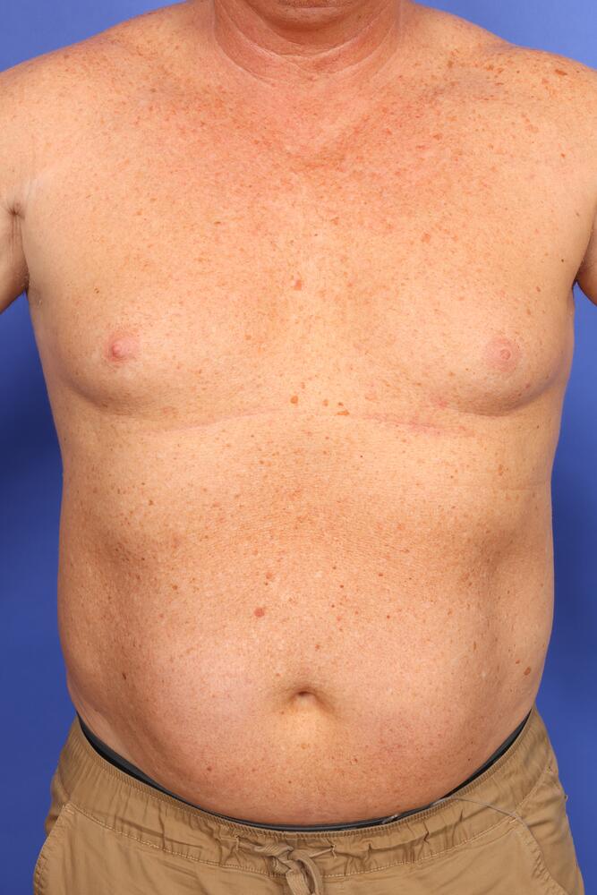 Gynecomastia Before & After Image