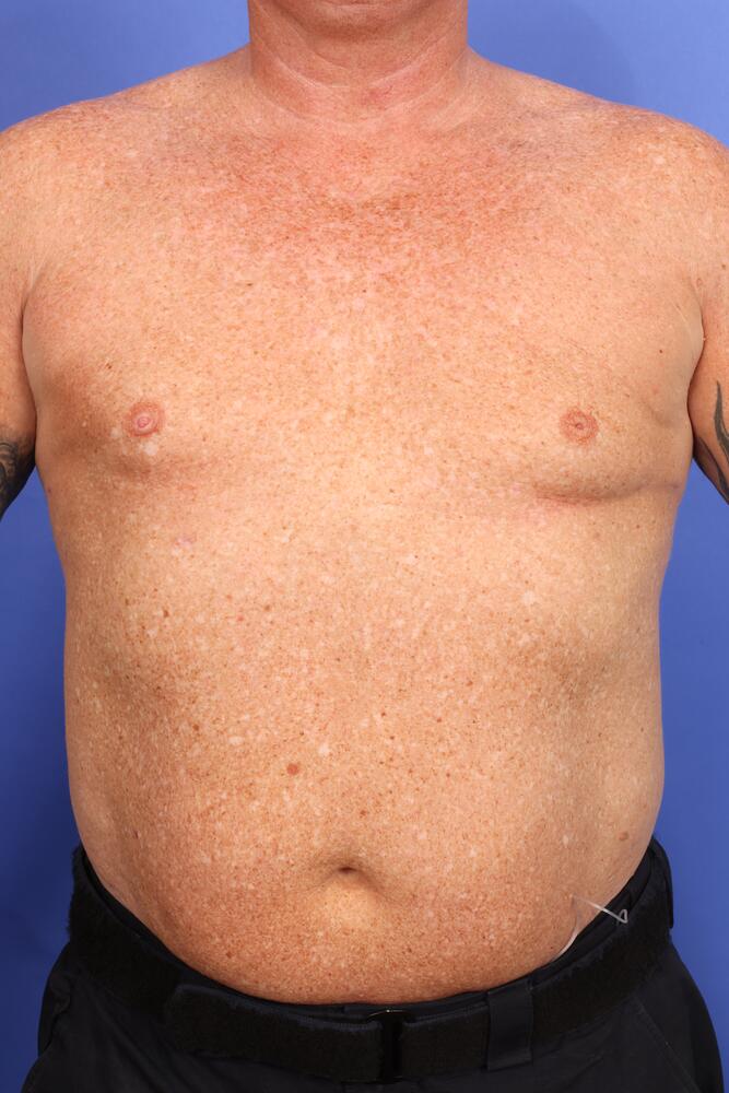 Gynecomastia Before & After Image