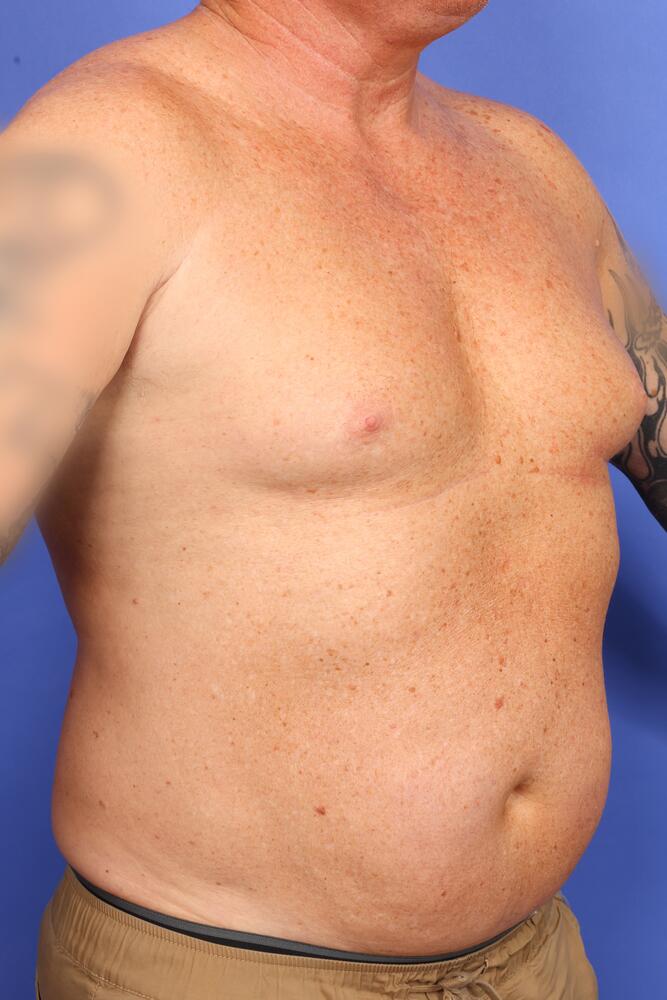 Gynecomastia Before & After Image