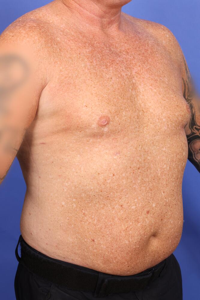 Gynecomastia Before & After Image