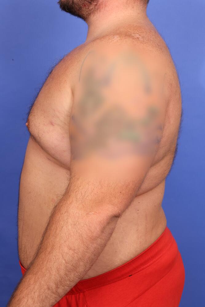 Gynecomastia Before & After Image