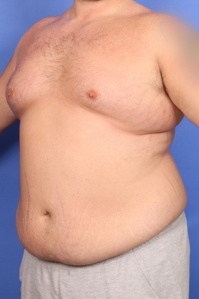 Gynecomastia Before & After Image