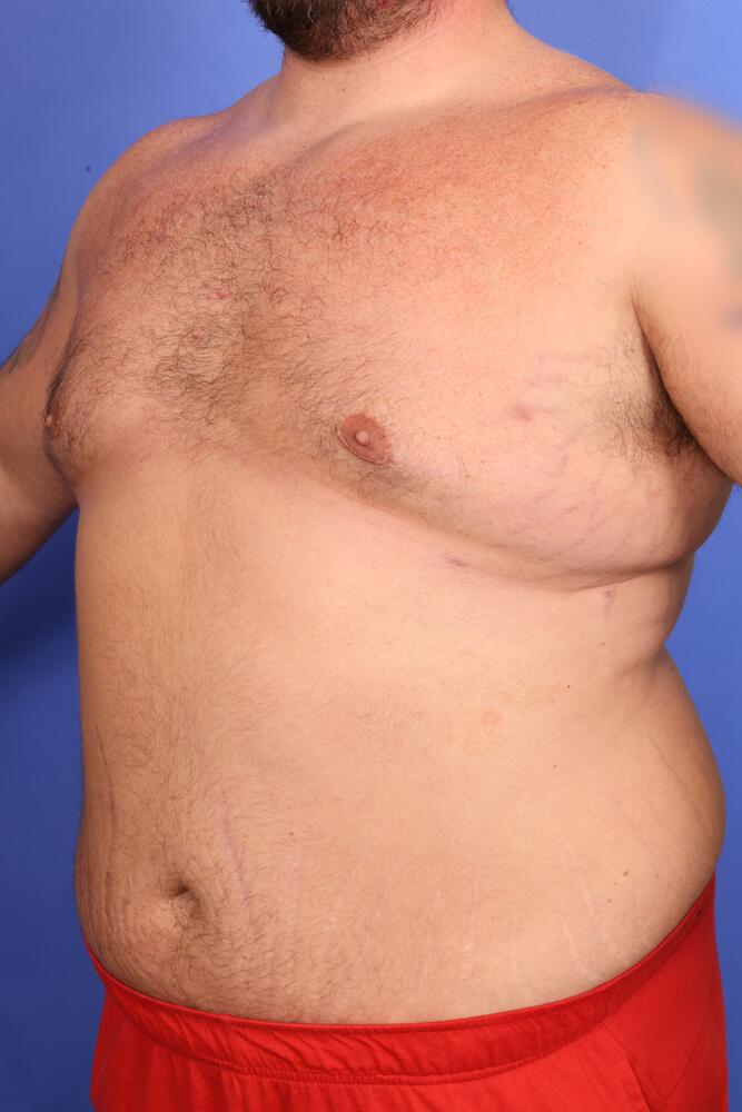 Gynecomastia Before & After Image