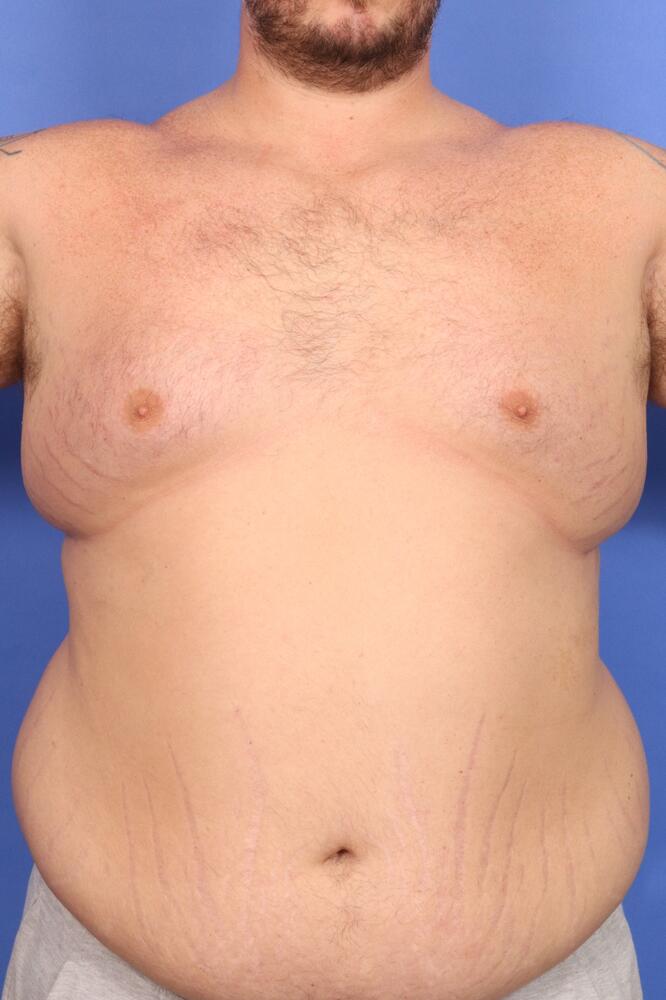 Gynecomastia Before & After Image