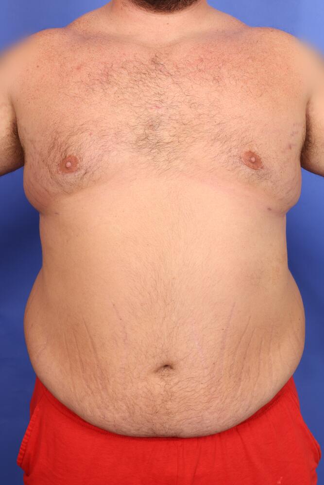 Gynecomastia Before & After Image