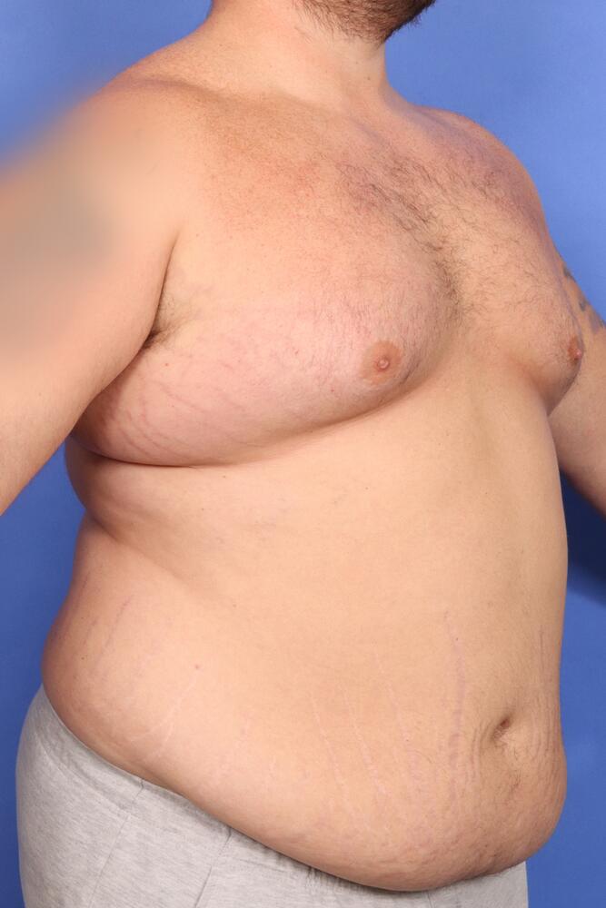 Gynecomastia Before & After Image