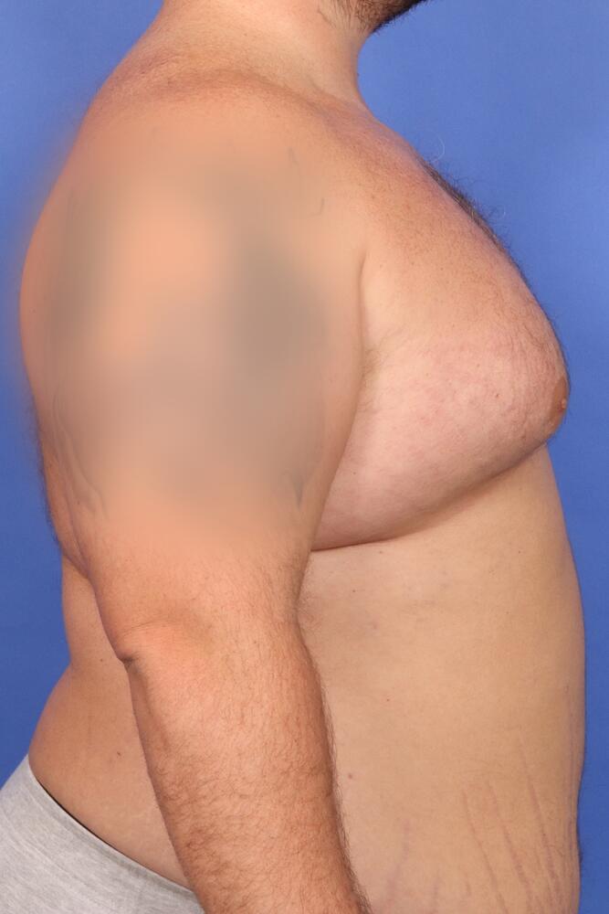 Gynecomastia Before & After Image