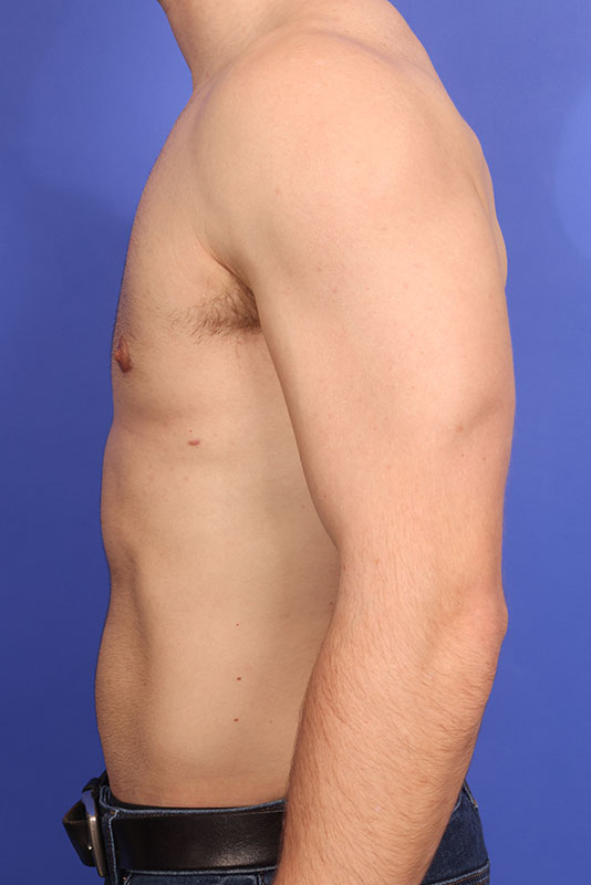 Gynecomastia Before & After Image