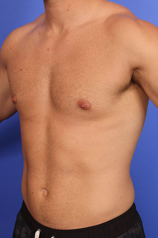 Gynecomastia Before & After Image