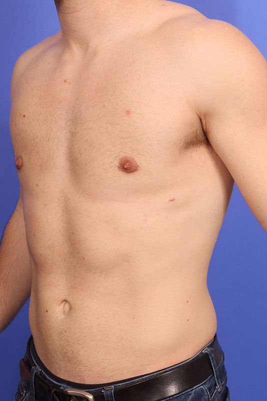 Gynecomastia Before & After Image