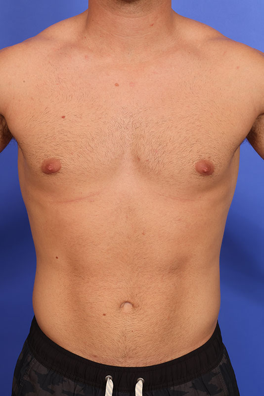 Gynecomastia Before & After Image