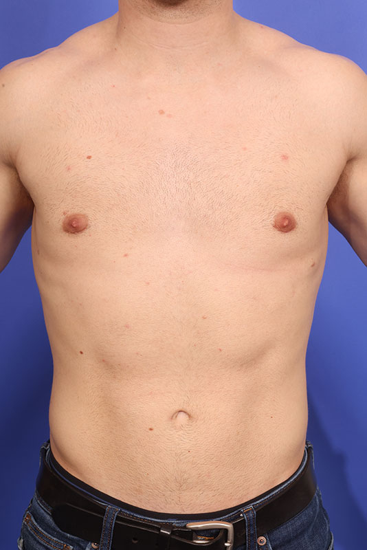 Gynecomastia Before & After Image