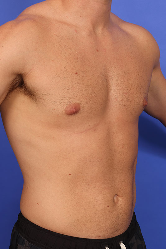 Gynecomastia Before & After Image