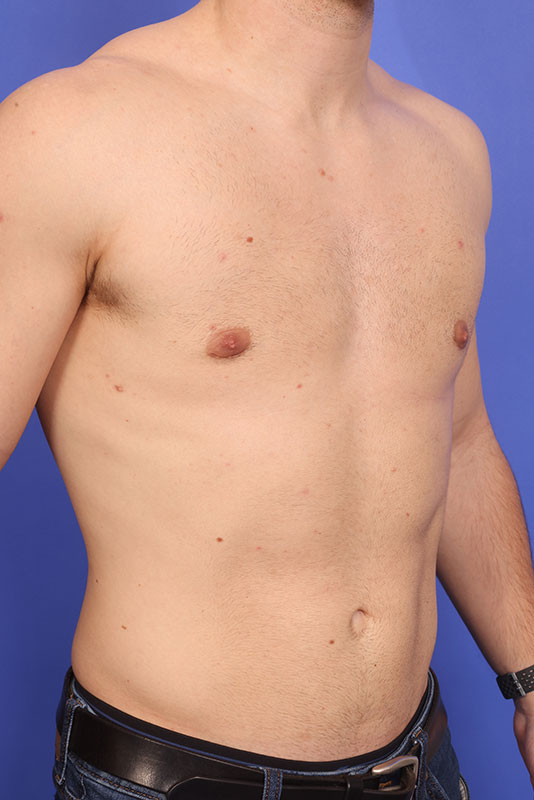 Gynecomastia Before & After Image