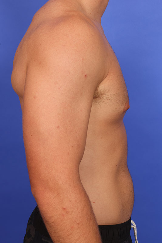 Gynecomastia Before & After Image