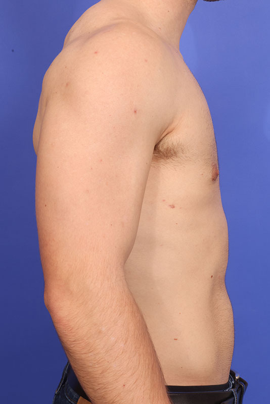 Gynecomastia Before & After Image