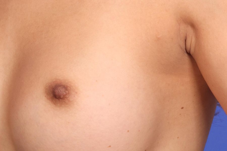 Nipple Reduction Before & After Image