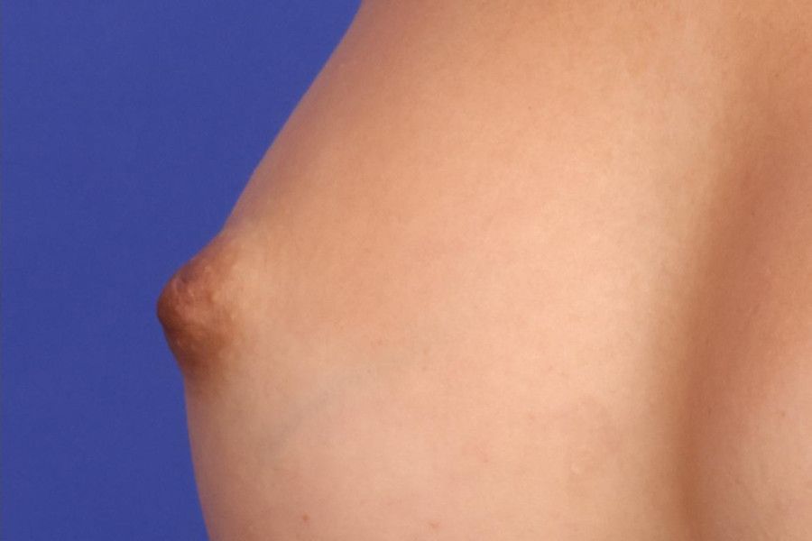 Nipple Reduction Before & After Image