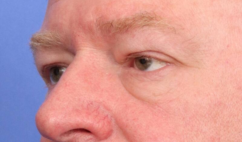 Blepharoplasty Before & After Image