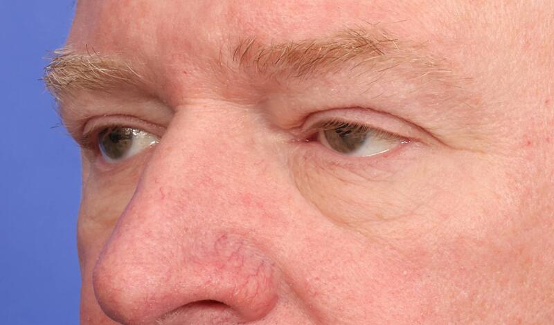 Blepharoplasty Before & After Image