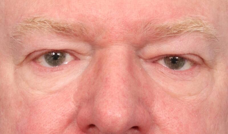 Blepharoplasty Before & After Image