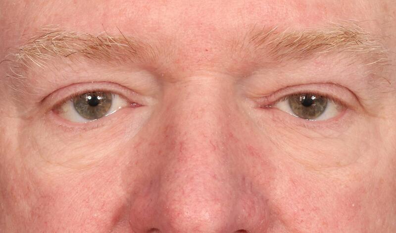 Blepharoplasty Before & After Image