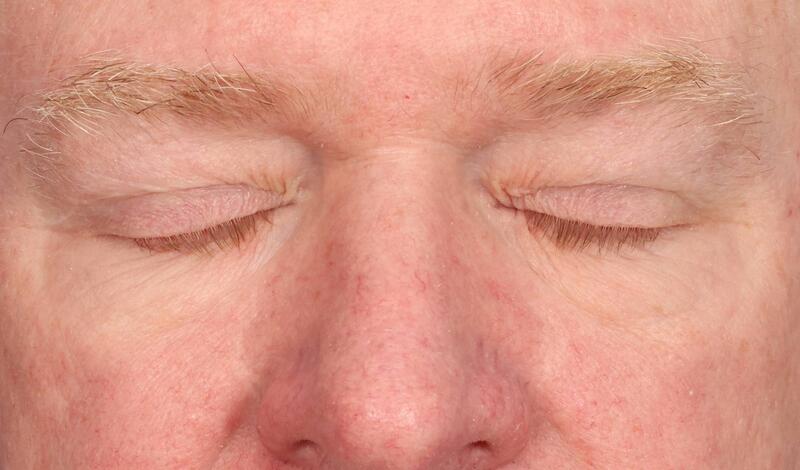 Blepharoplasty Before & After Image