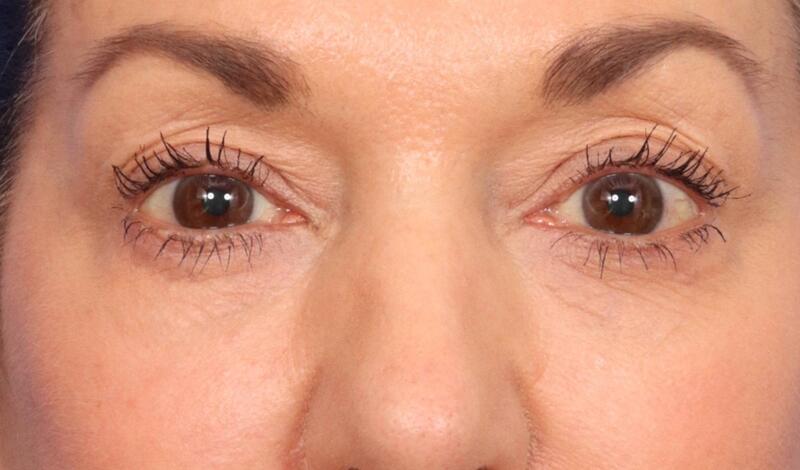 Blepharoplasty Before & After Image