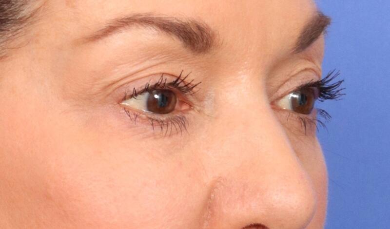 Blepharoplasty Before & After Image