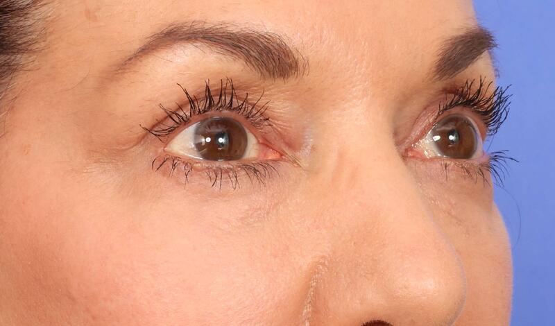 Blepharoplasty Before & After Image