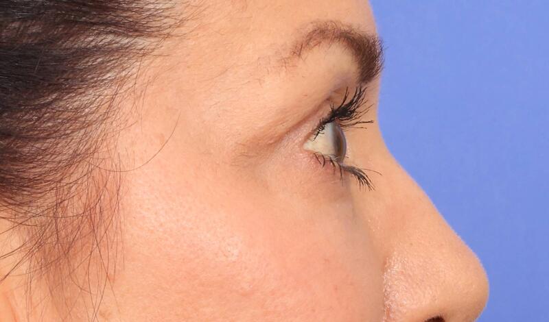 Blepharoplasty Before & After Image