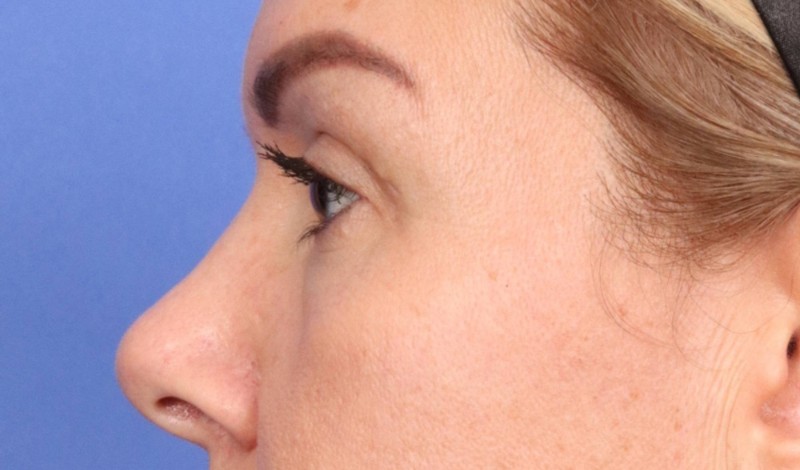 Blepharoplasty Before & After Image