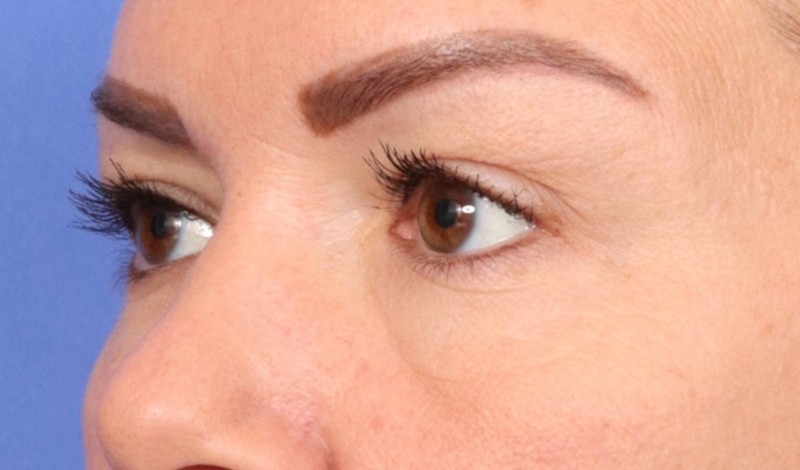 Blepharoplasty Before & After Image