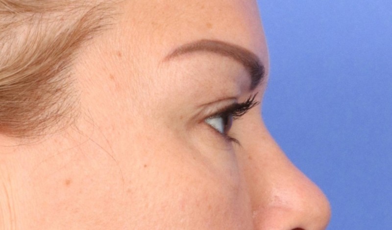 Blepharoplasty Before & After Image