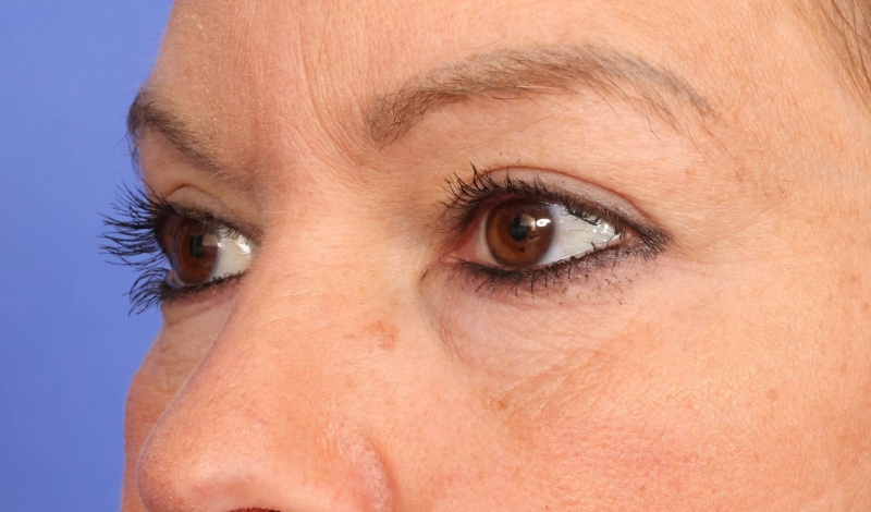 Blepharoplasty Before & After Image