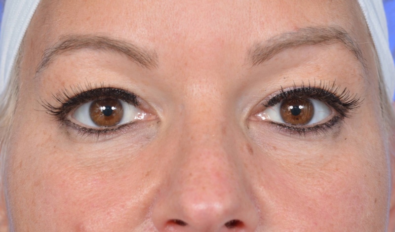 Blepharoplasty Before & After Image